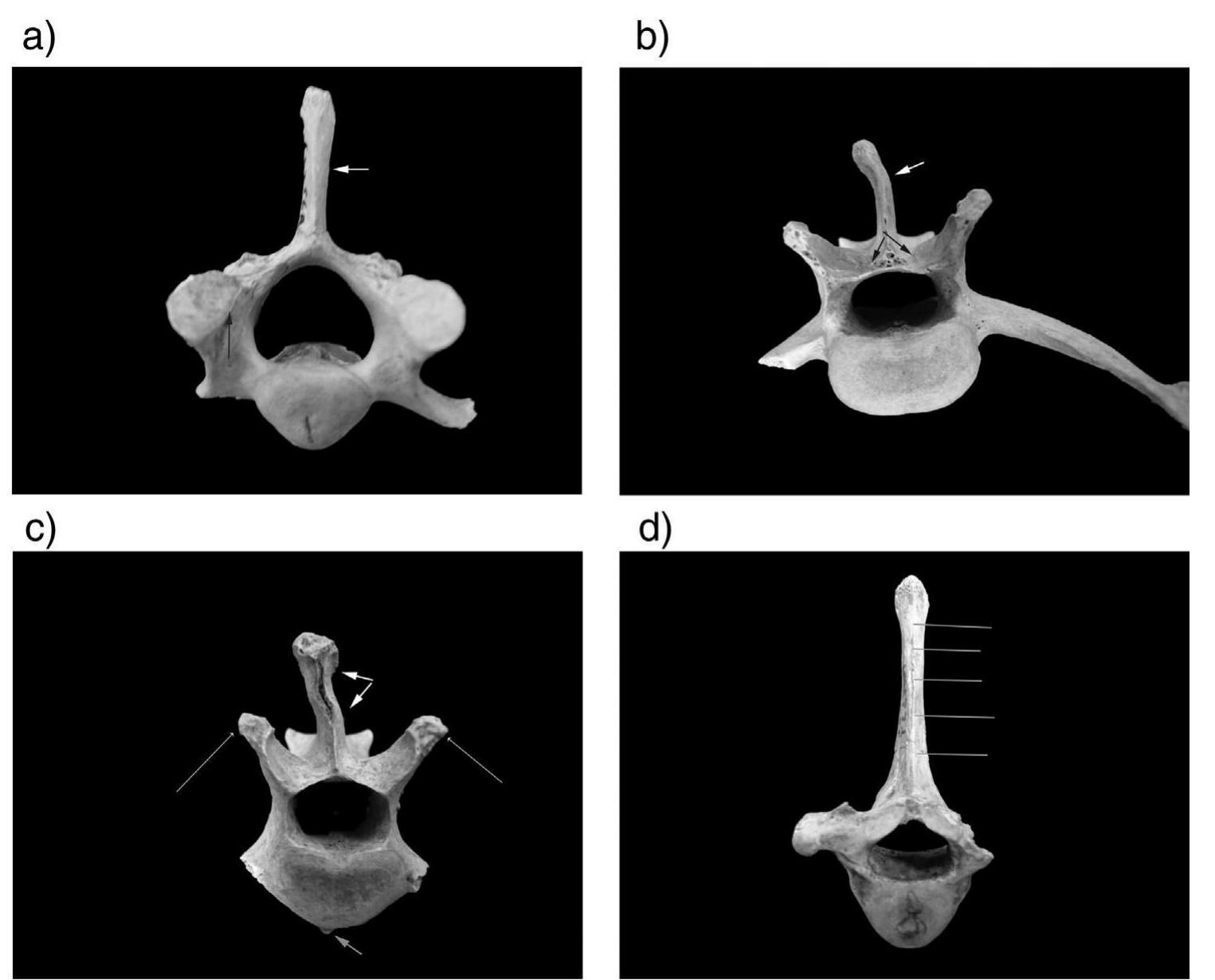 Figure 1 - from Differential diagnosis of vertebral spinous