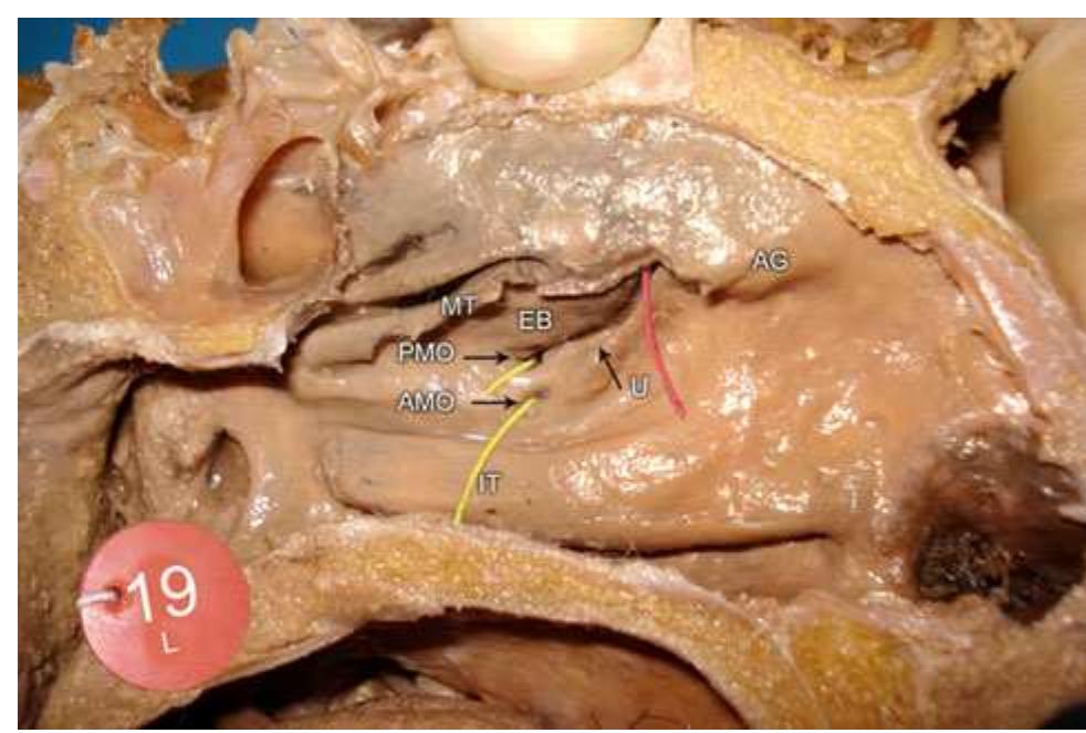 Accessory Ostium (PDF) The location of maxillary sinus ostium and its clinical application