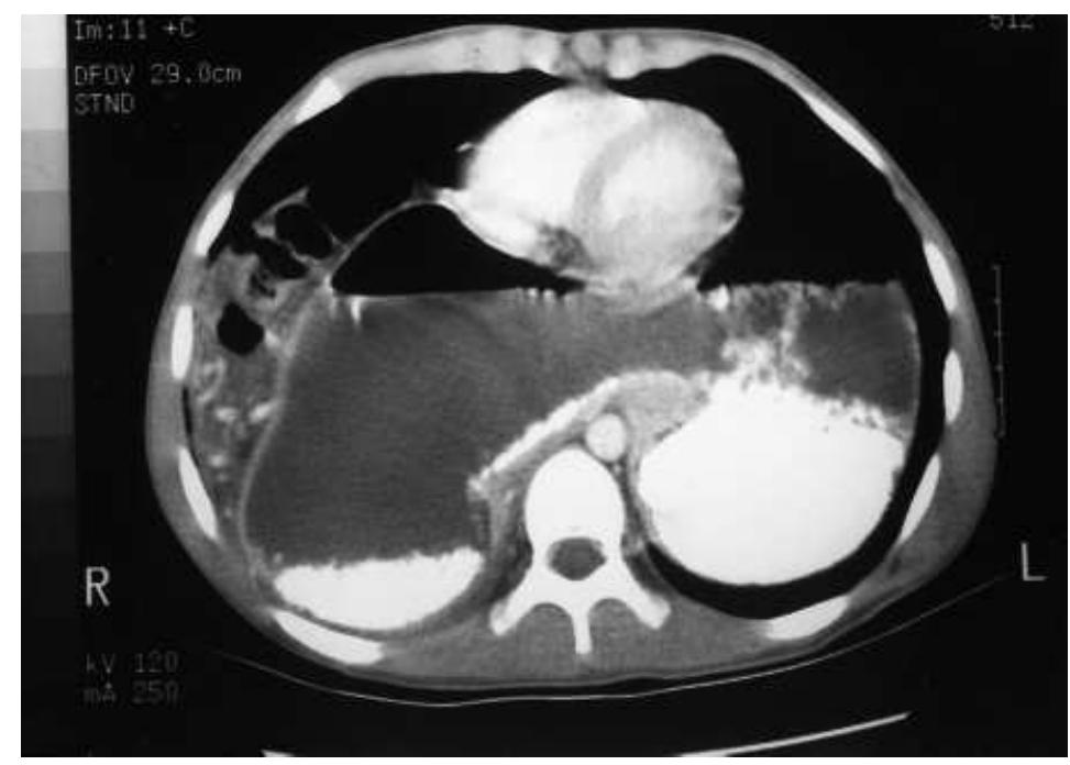 Eventration Ct (PDF) Bilateral eventration of the diaphragm with perforated gastric ...