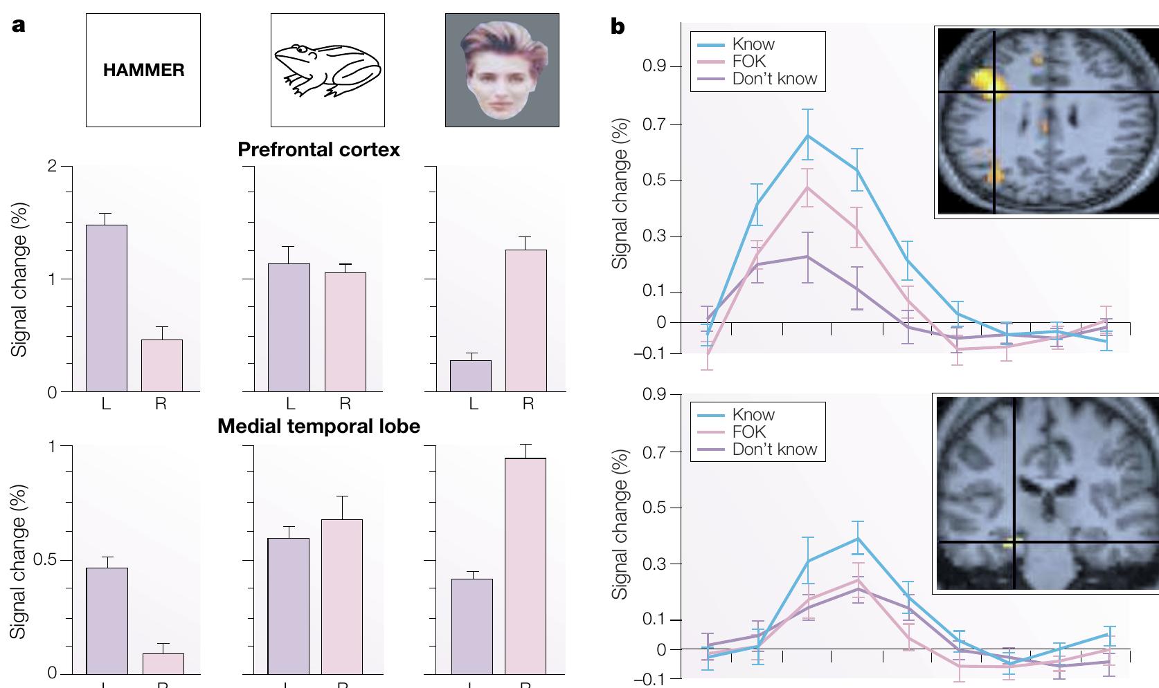 (PDF) Prefrontal and medial temporal lobe interactions in long-term memory