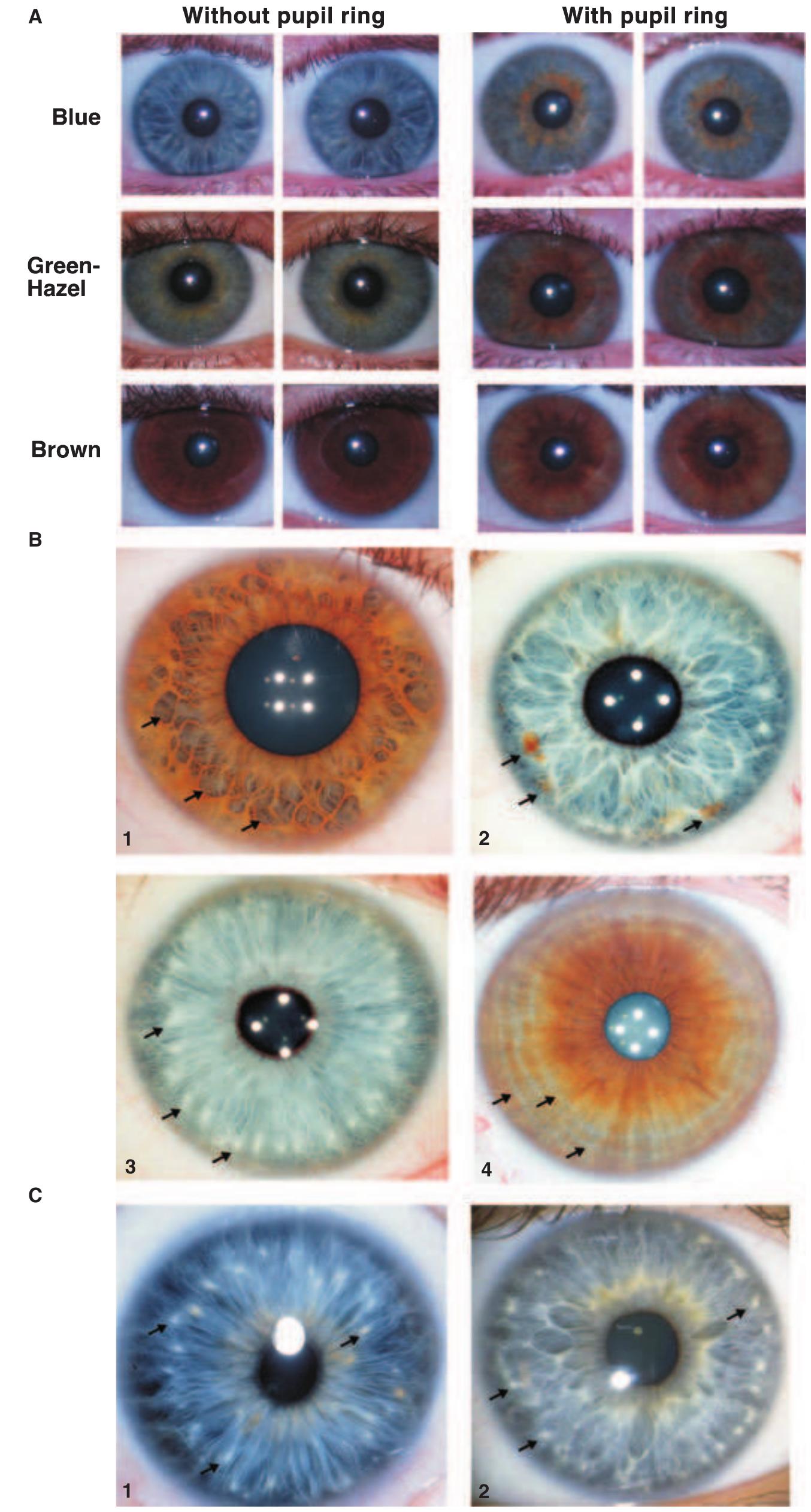 Inheritance of eye colour in a non-mendelian fashion. the