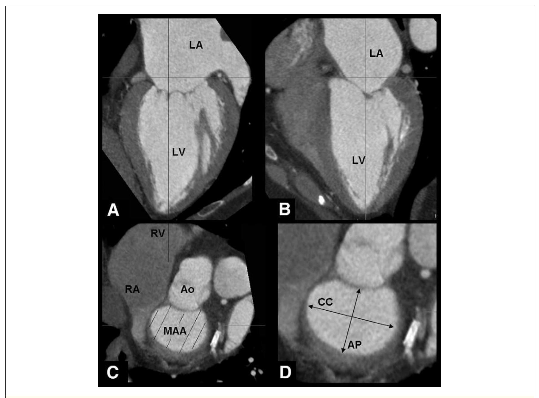 (PDF) Assessment of Mitral Valve Anatomy and Geometry With Multislice ...