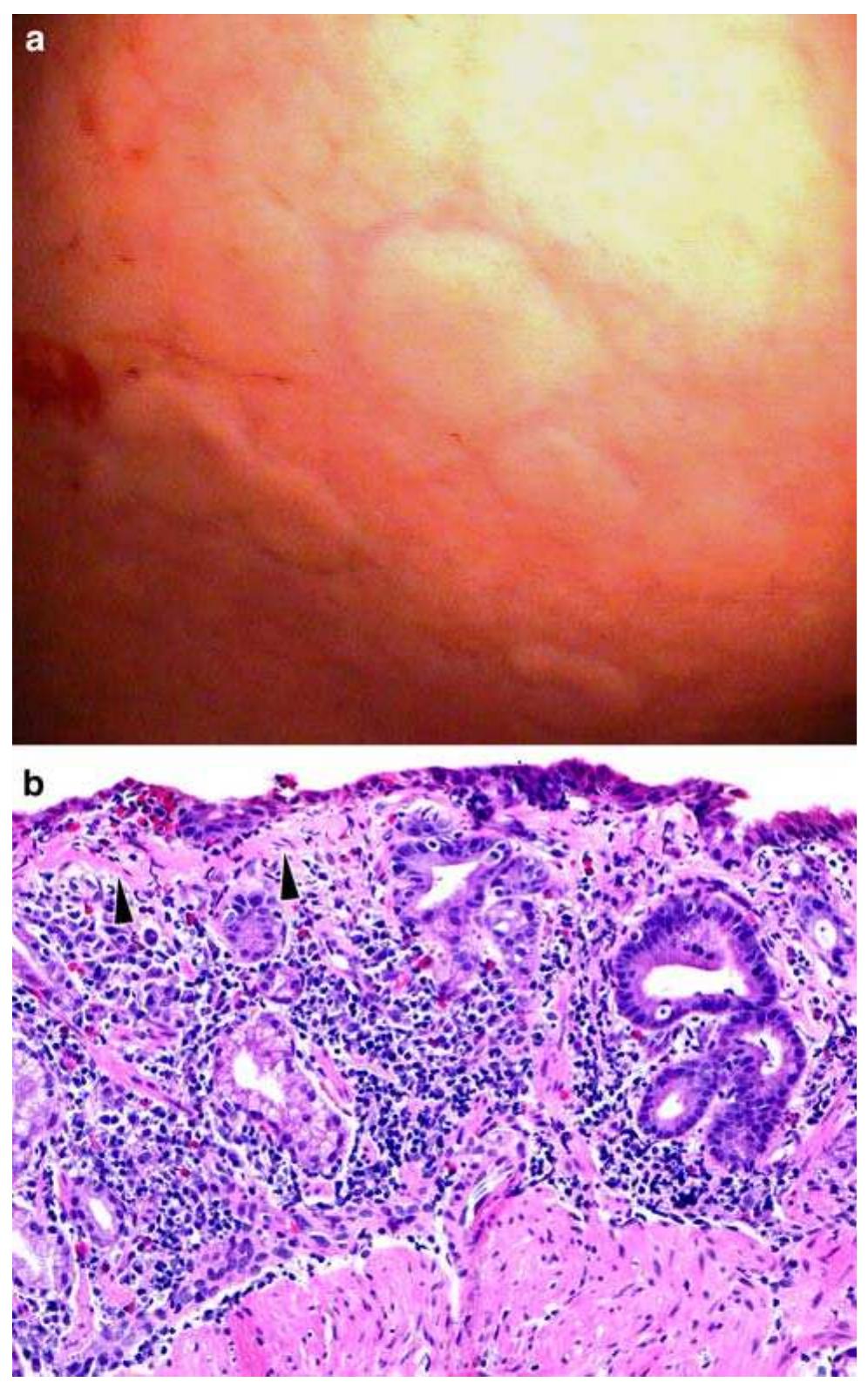 Gastric candidiasis: the gastric mucosa is diffusely