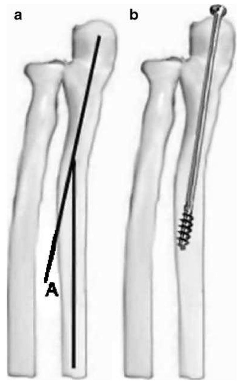 Ulna Varus (PDF) Contoured plating for proximal ulna nonunion: an improved technique