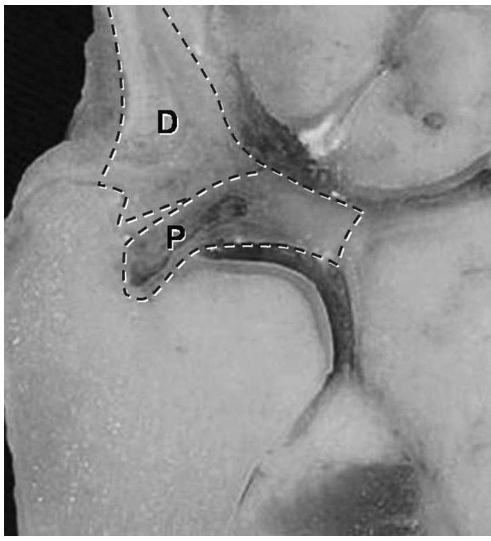 Ucl Components (PDF) Arthroscopic Foveal Repair of Triangular Fibrocartilage Complex ...