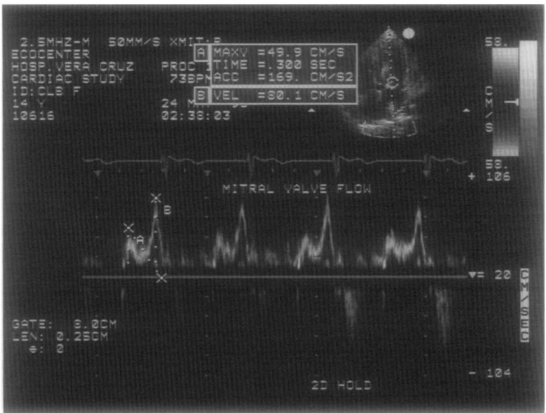 Mital Inflow Pattern Pulsed doppler tracing of the mitral valve inflow obtained