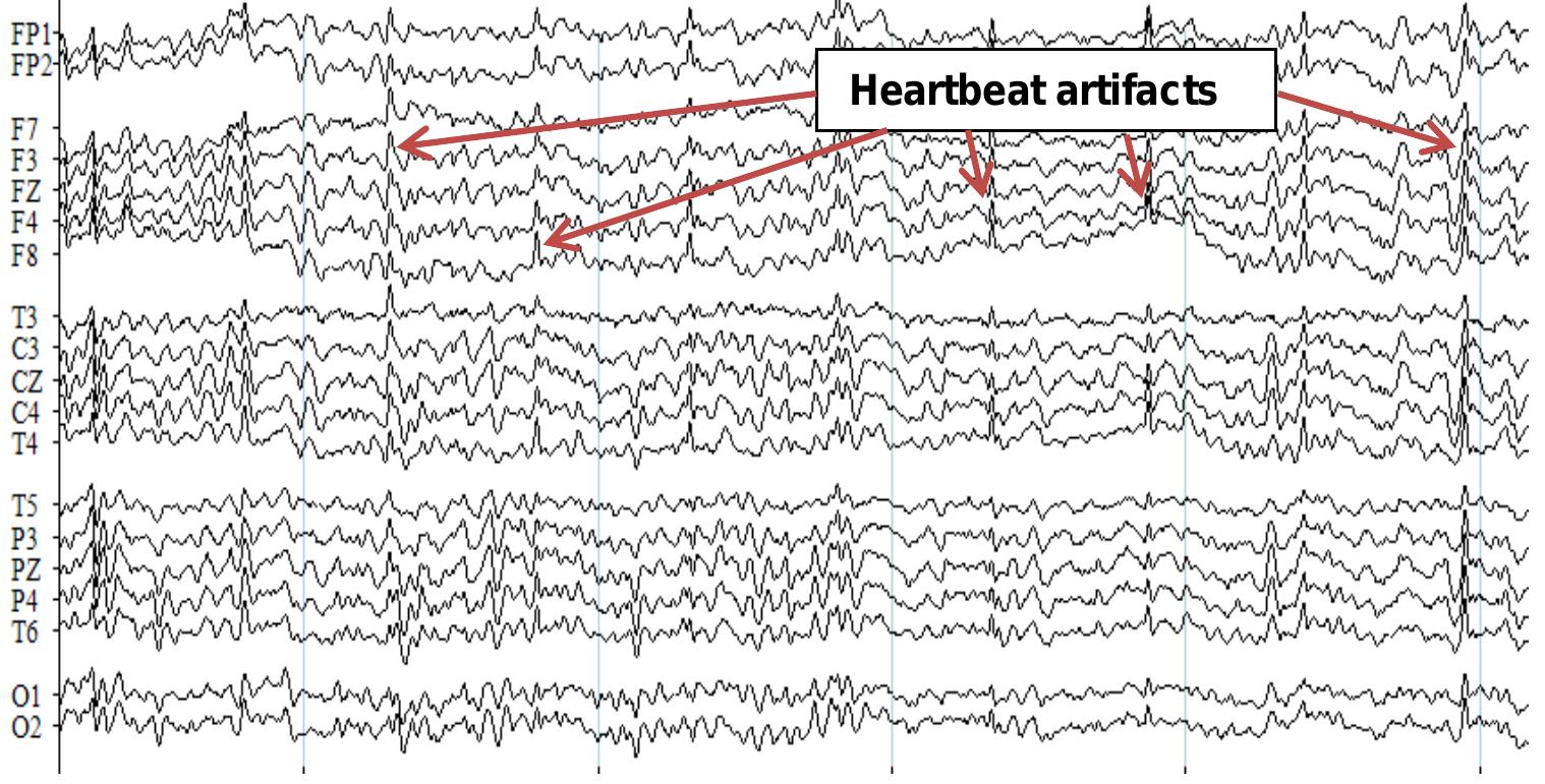 Qeeg of a 40-y ear-old male at four minutes of 17 hz ave