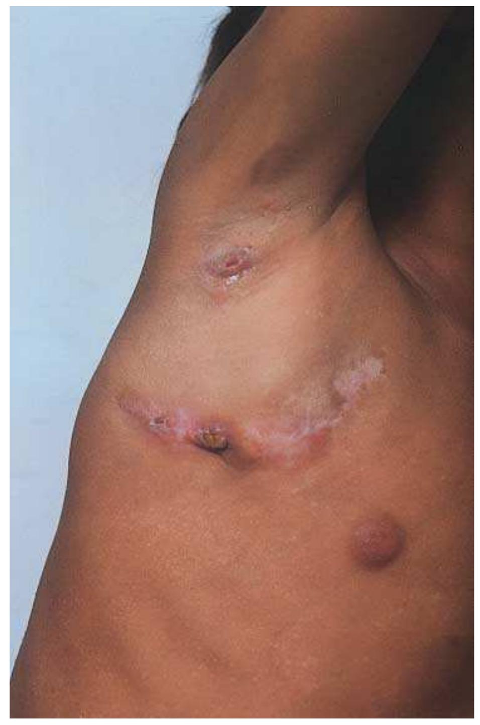 Sclerofuloderma Scrofuloderma with grouped lesions of lichen scrofulosorum.