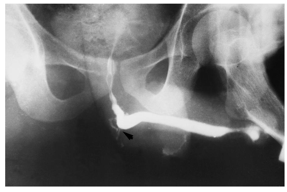 (PDF) Watering can perineum - a forgotten complication of gonorrhoea
