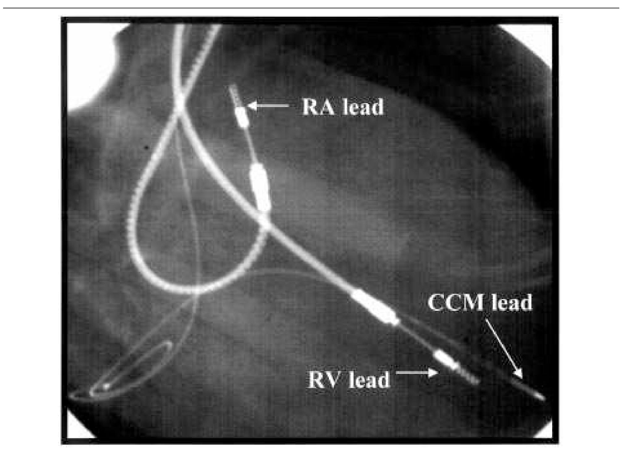 (PDF) Cardiac contractility modulation with the impulse dynamics signal ...