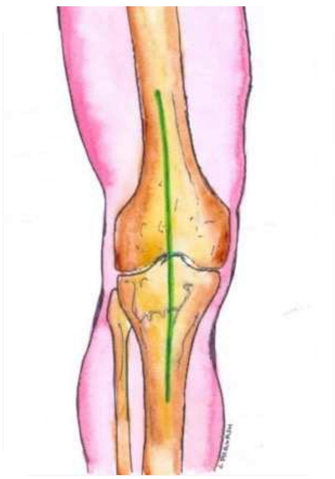 Straight midline incision centred over patella extending