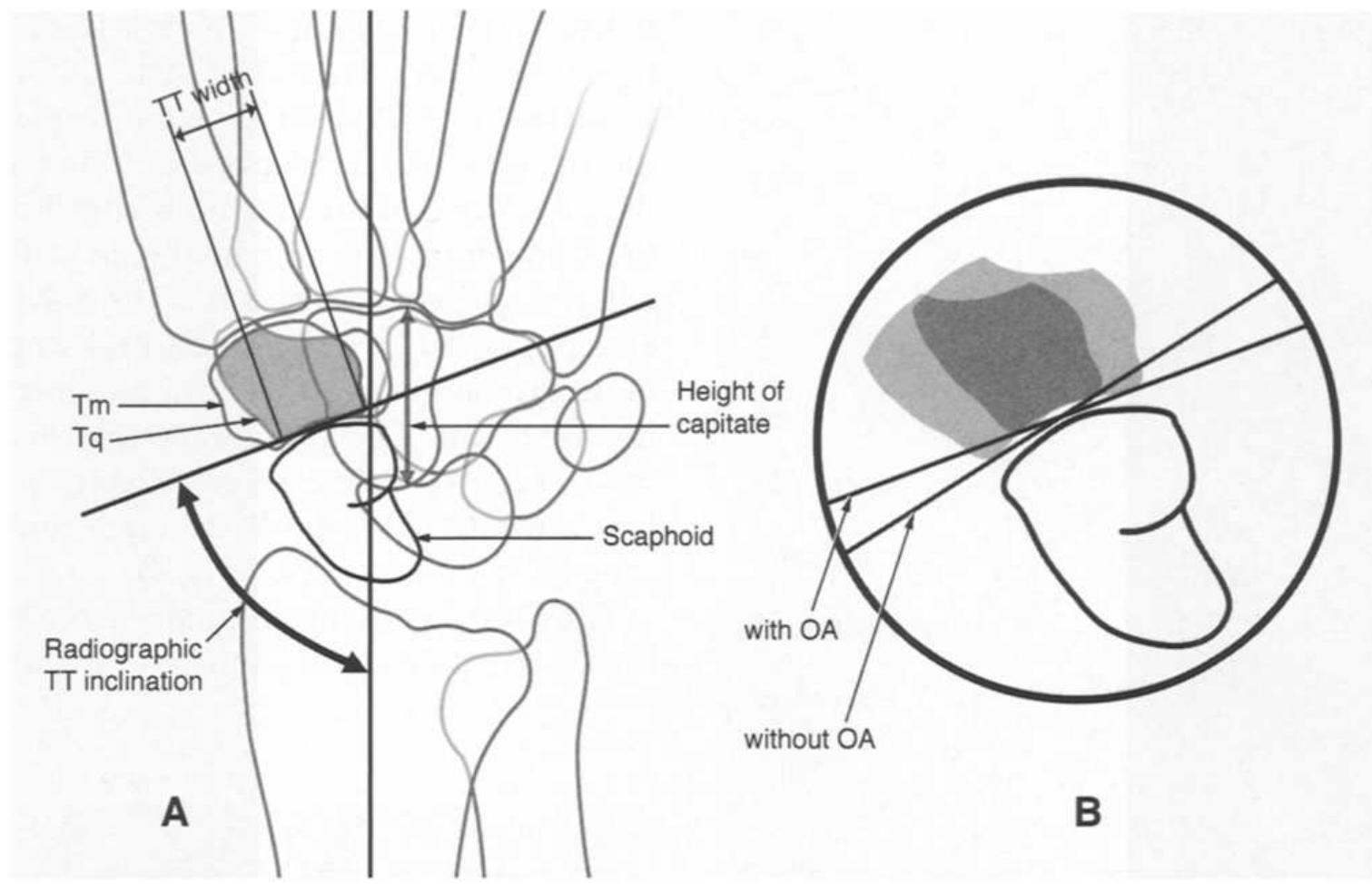 Scaphoid Multangular Joint (PDF) Scaphoid anatomy and mechanics: update and review