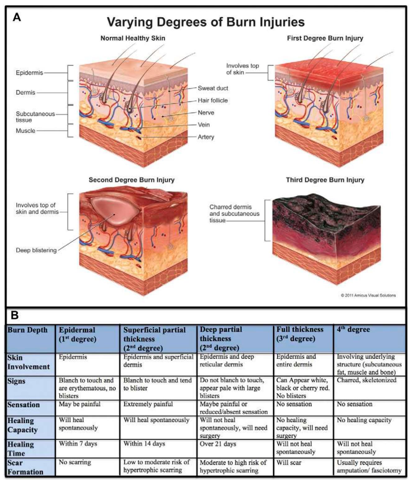 Figure 1 - from Burn Management in Orthopaedic Trauma: A