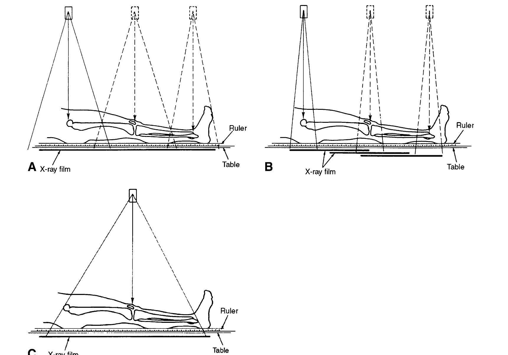 (PDF) Methods for Assessing Leg Length Discrepancy