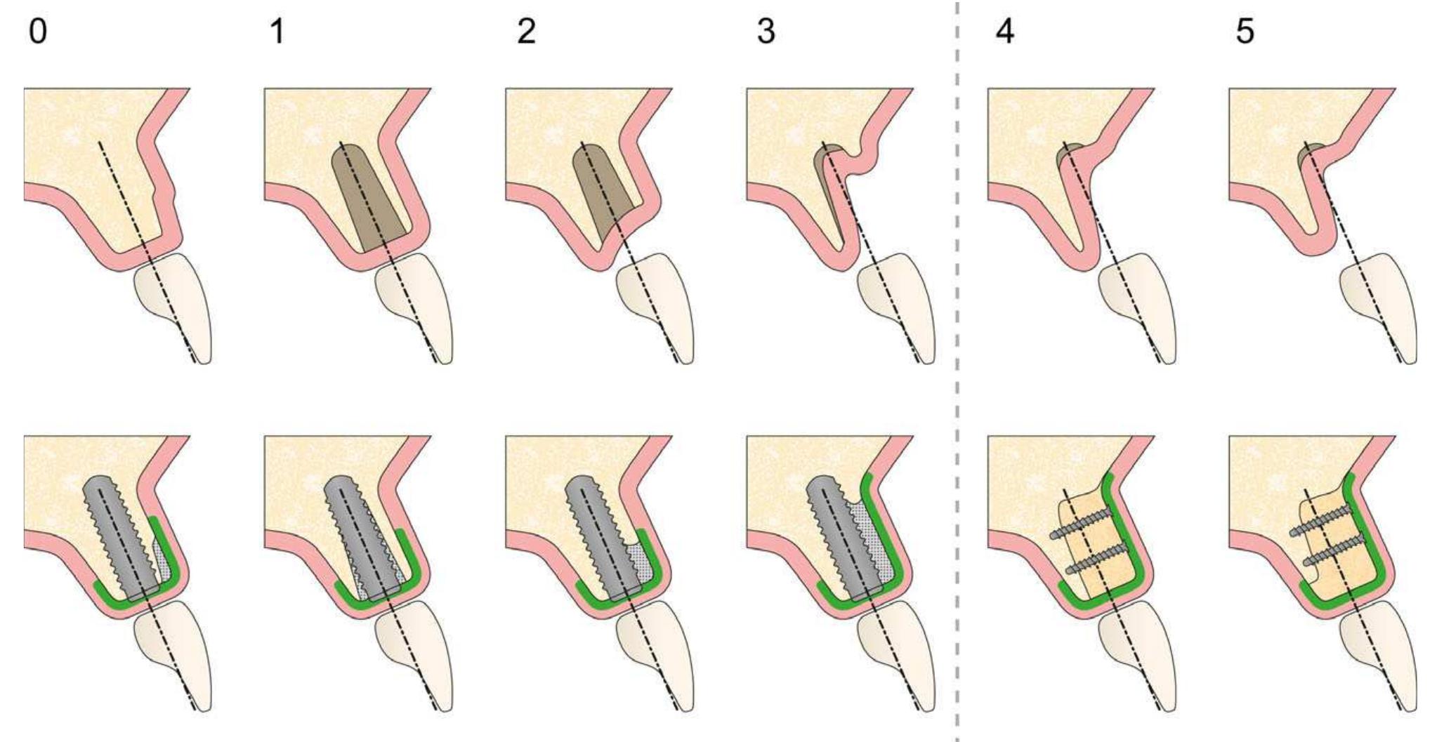 Schema displaying bone defect classes 0-5 and the