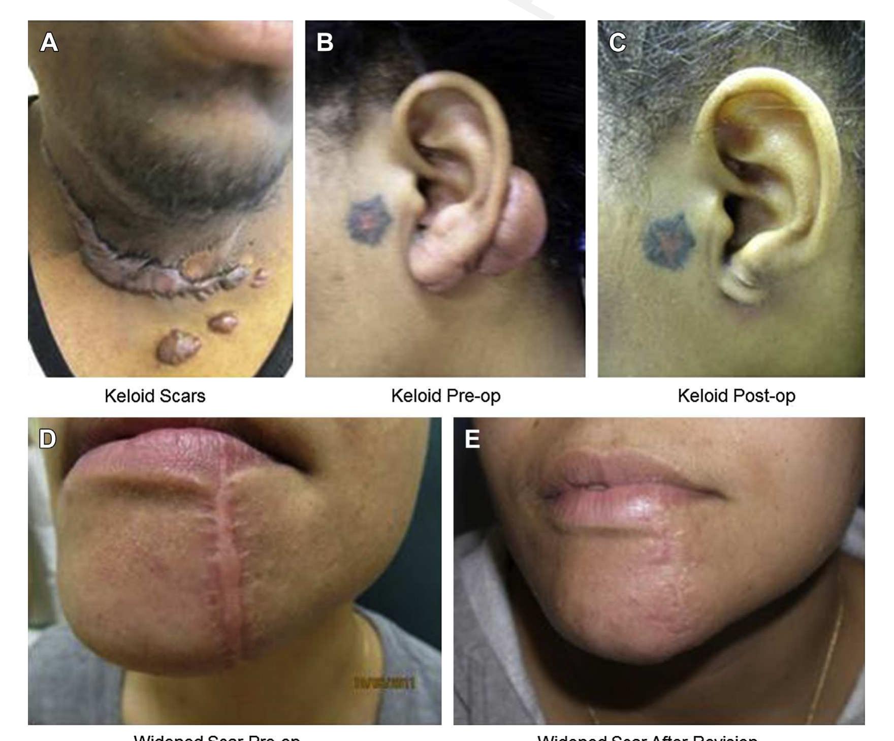 Example Of Scars Examples of hypertrophic scars are shown for a caucasian