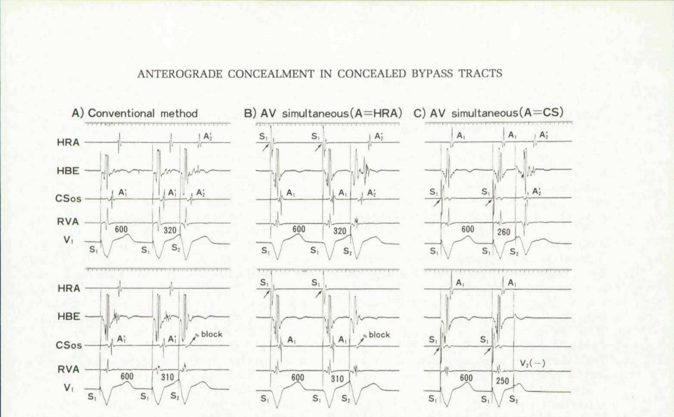 Retrograde Accessory Pathway (PDF) Electrophysiological Demonstration of Anterograde Concealed ...