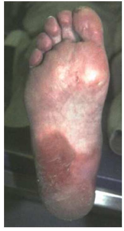PDF) Palmarplantar erythrodysesthesia (PPE): A literature review with  commentary on experience in a cancer centre