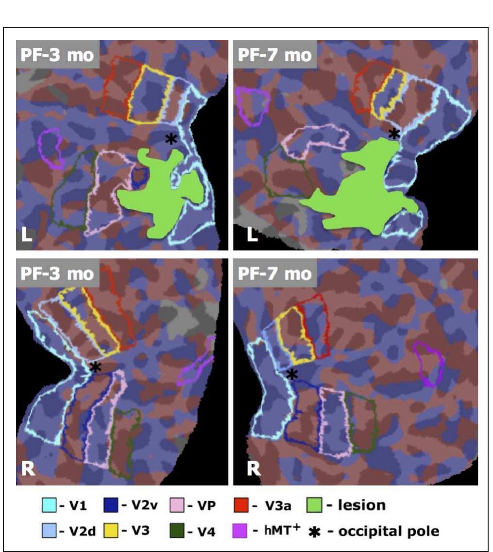 Retinotopic maps for a retrospective patient study (patient