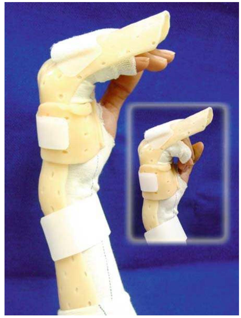 1 controlled active flexor splint.