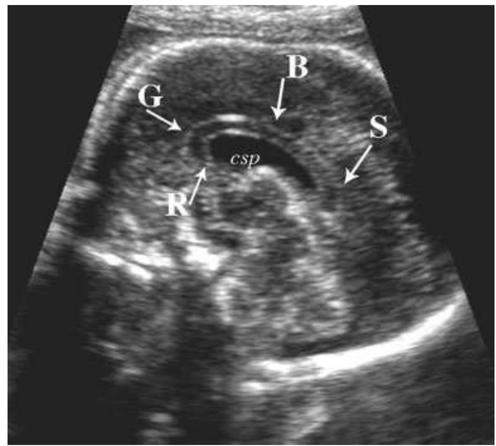 Prosencephalic Development (PDF) Disorders of prosencephalic development
