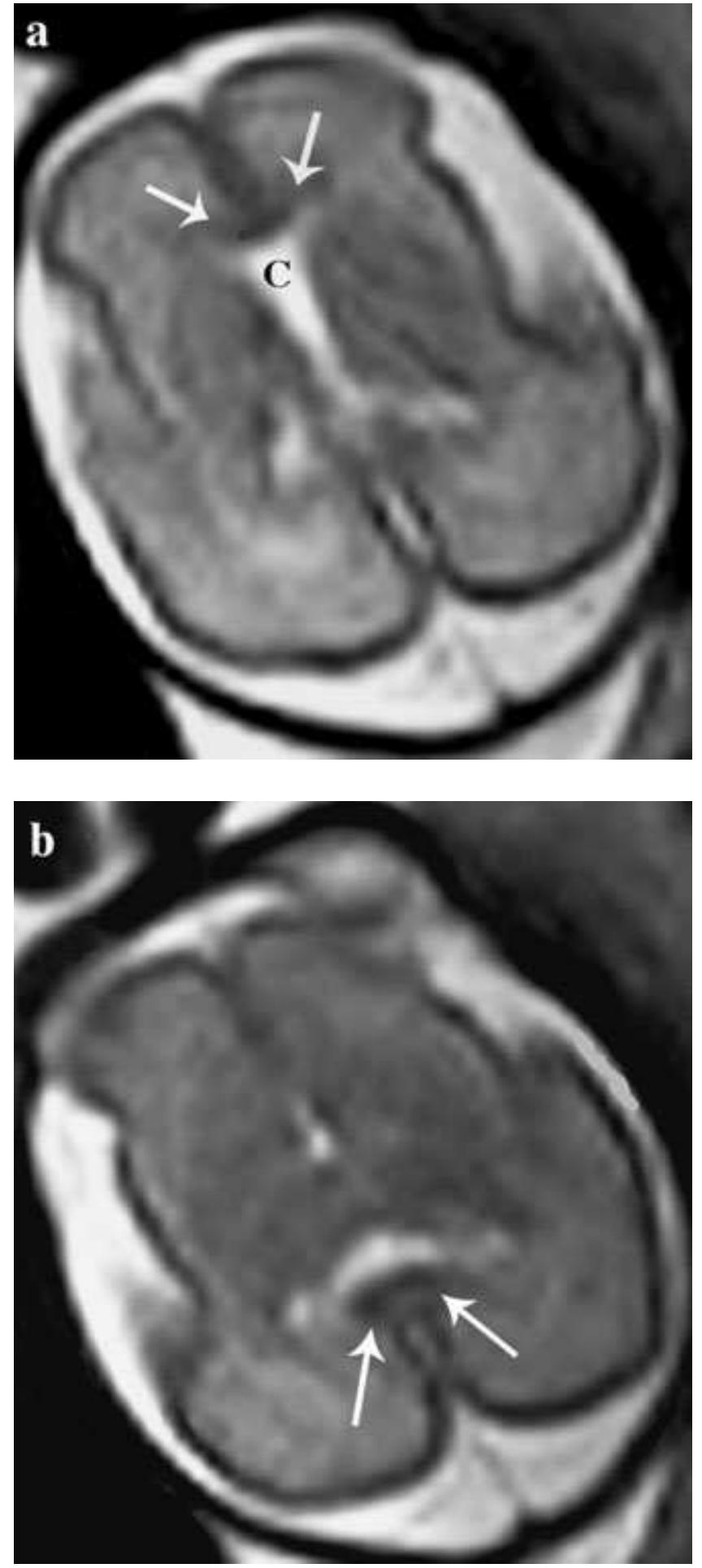 Prosencephalic Development (PDF) Disorders of prosencephalic development