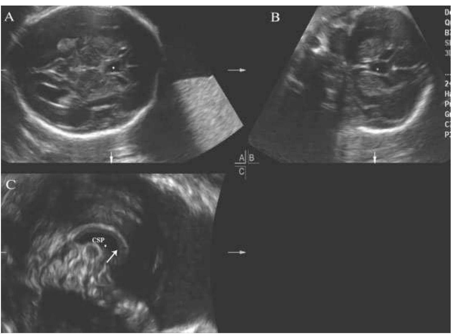 Prosencephalic Development (PDF) Disorders of prosencephalic development