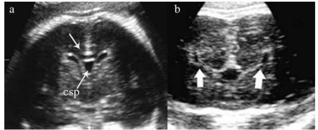Prosencephalic Development (PDF) Disorders of prosencephalic development