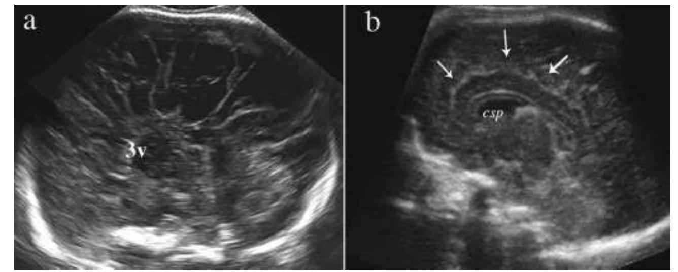 Prosencephalic Development (PDF) Disorders of prosencephalic development