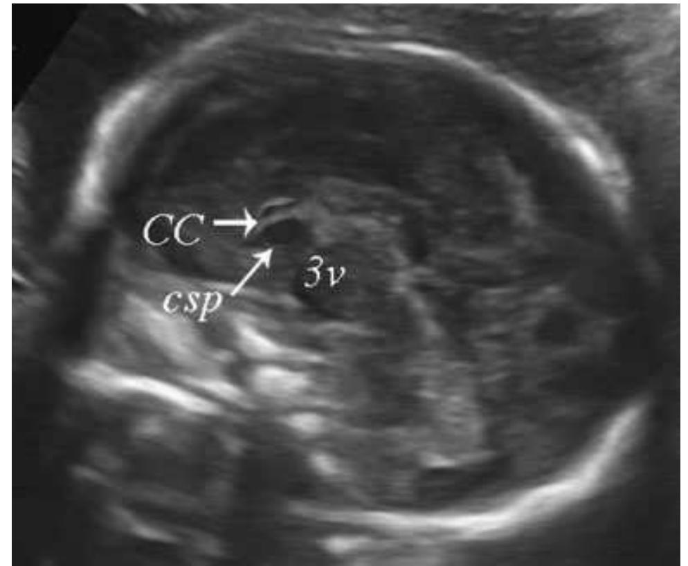 Prosencephalic Development (PDF) Disorders of prosencephalic development