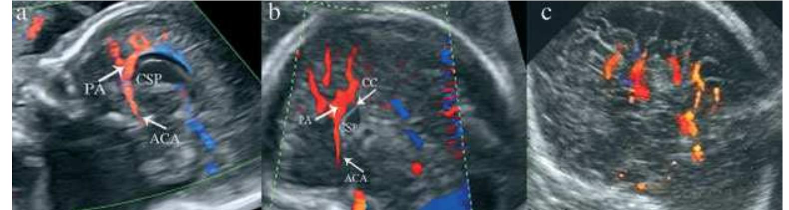 Prosencephalic Development (PDF) Disorders of prosencephalic development