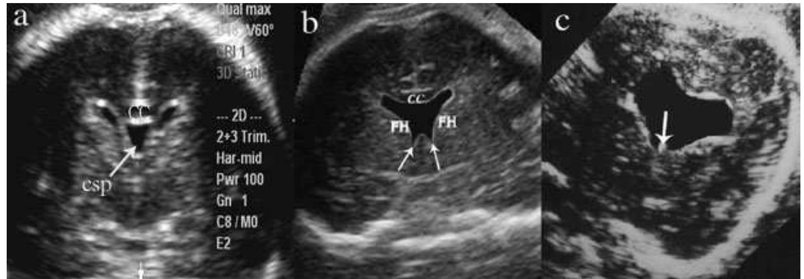 Prosencephalic Development (PDF) Disorders of prosencephalic development