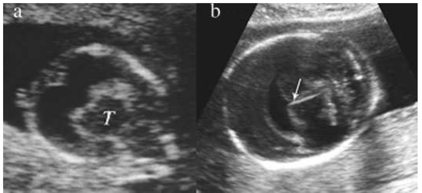 Prosencephalic Development (PDF) Disorders of prosencephalic development