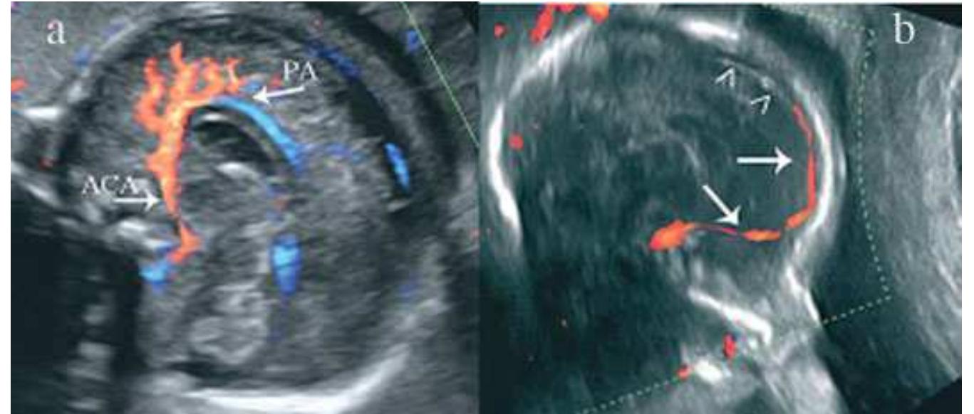 Prosencephalic Development (PDF) Disorders of prosencephalic development