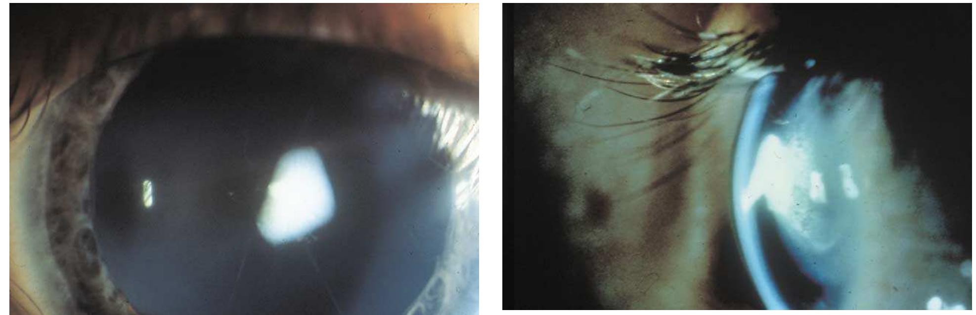 Left Small Anterior Pyramidal Cataract Right Anterior