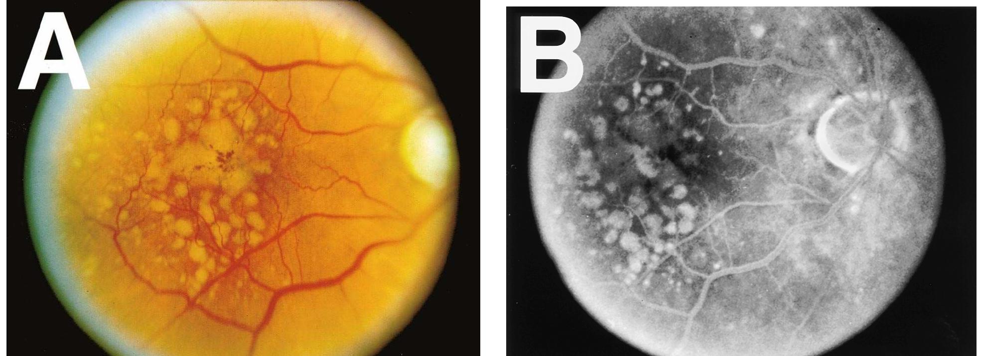 (PDF) Drusen in Age-Related Macular Degeneration