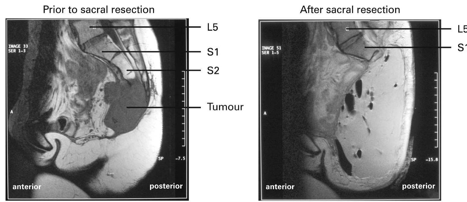 Sagital projection of recurrent rectal carcinoma on mri,