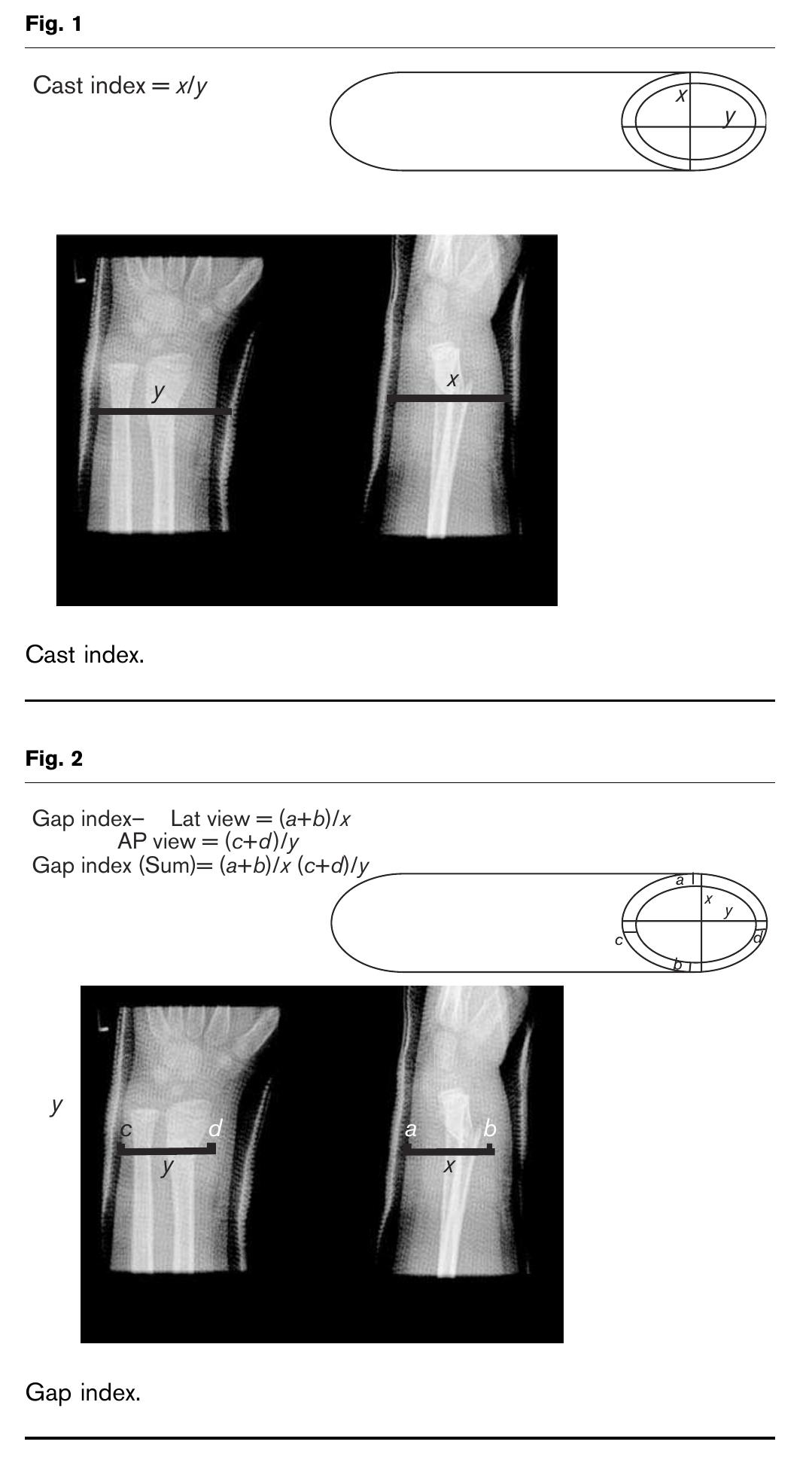 (PDF) Gap index: a good predictor of failure of plaster cast in distal ...