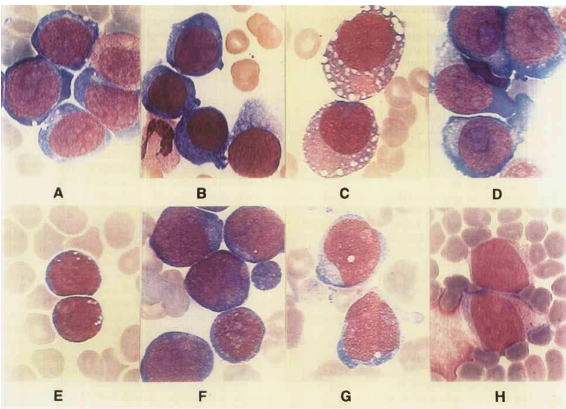 (PDF) Minimally differentiated erythroleukaemia (AML M6 Variant'): a ...