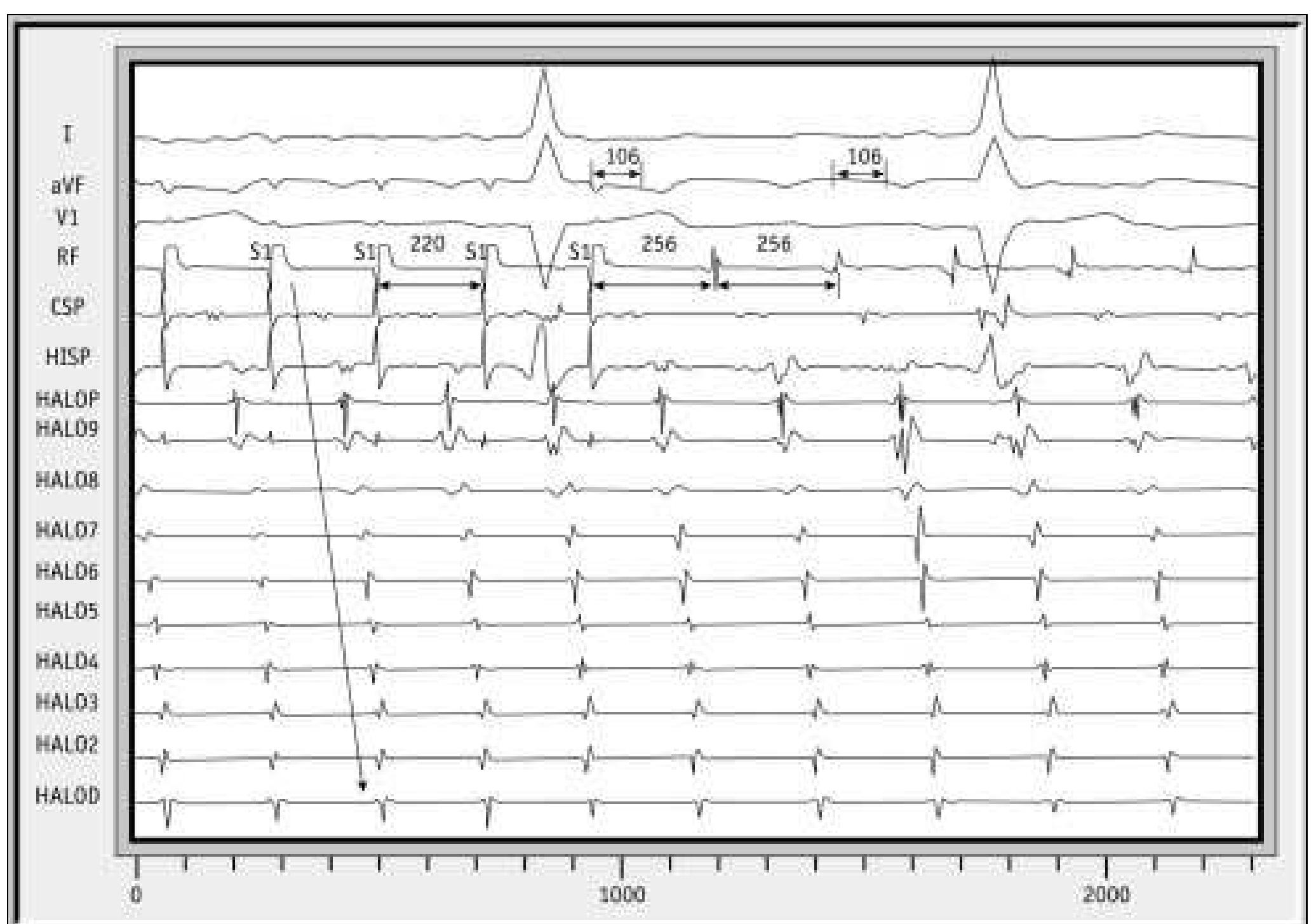 Figure 4 - Atrial flutter