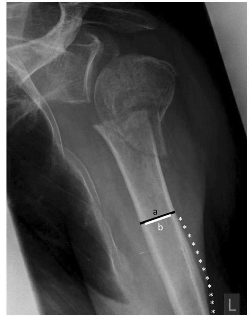 An ap radiograph shows a proximal humerus fracture in a 75-