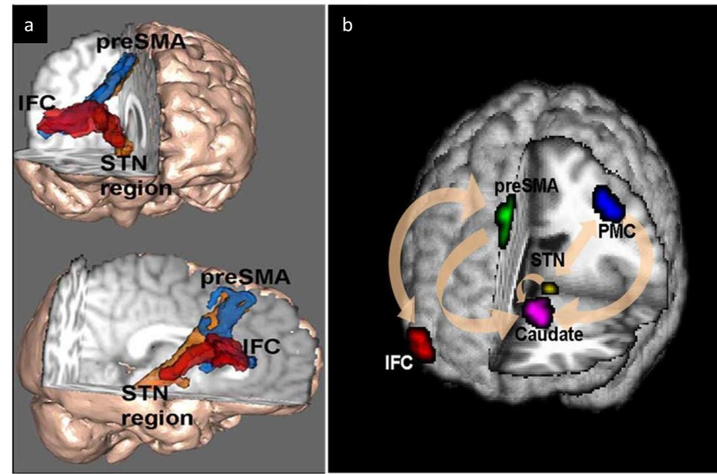 Sst Inhibitory Control (PDF) Inhibition and impulsivity: Behavioral and neural basis of ...