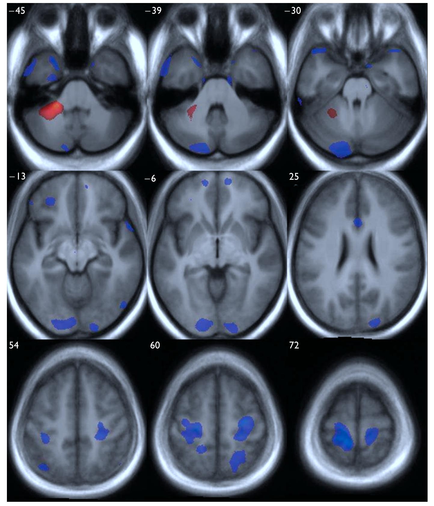 (PDF) A voxel-based morphometry study of gray matter in parents of ...