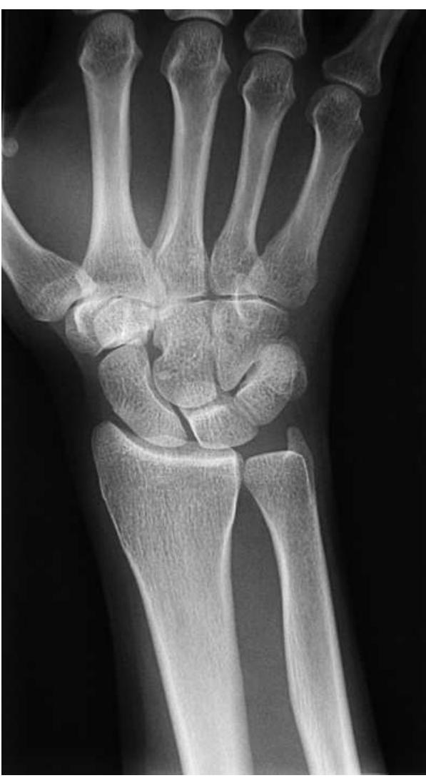 A true pa view of the wrist. note the ulnar and radial