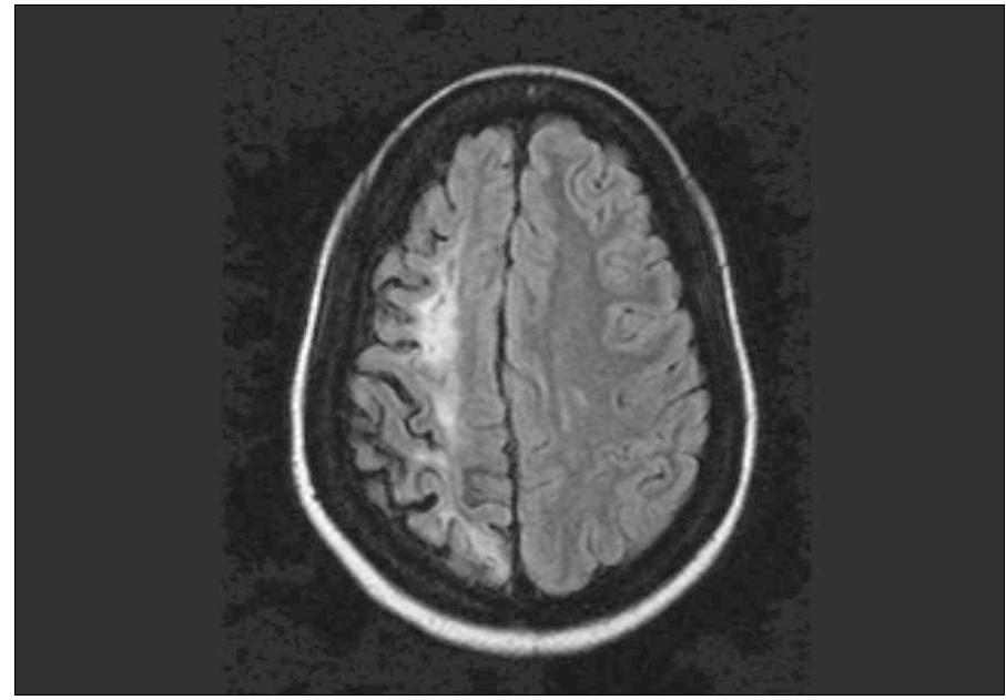 Flair sequence mri of the brain showing a right hemisphere