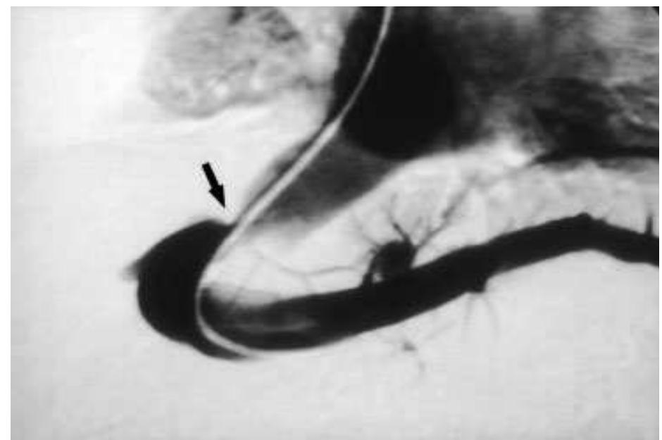Lateral view of hepatic venogram showing stenosis of hepatic