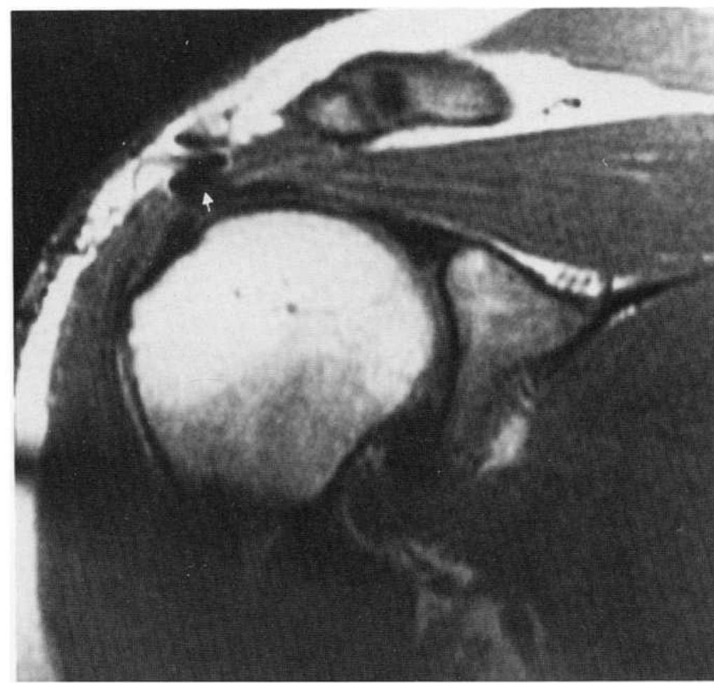 Figure 18 - Magnetic Resonance Imaging of the Shoulder