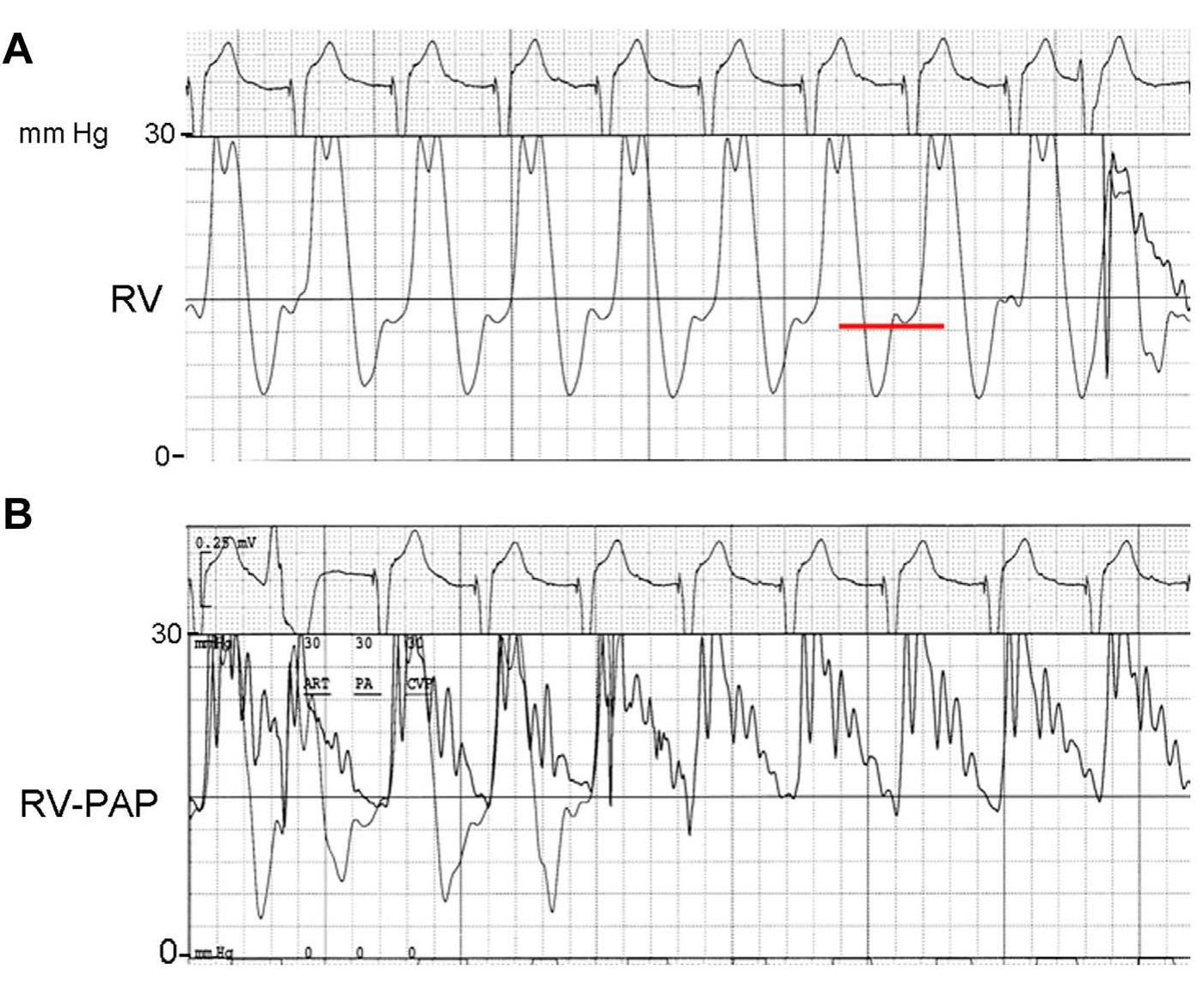 Pap From Rvsp Right ventricular (rv) (a) and pulmonary artery tracing (b)