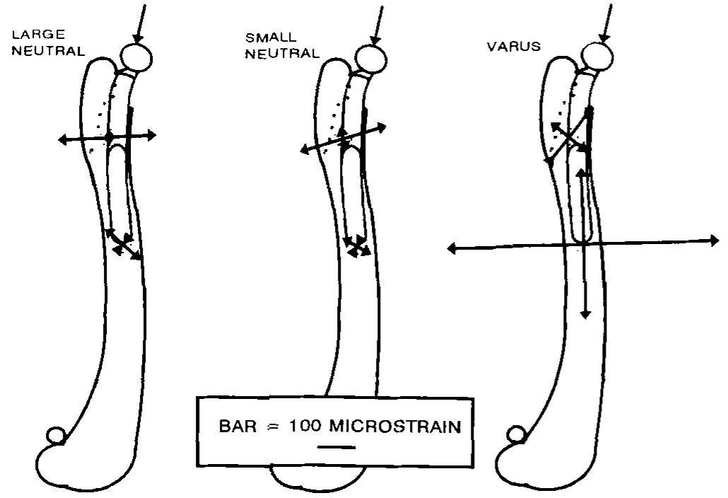 Varus Load Illustration of radiographic landmarks used to determine