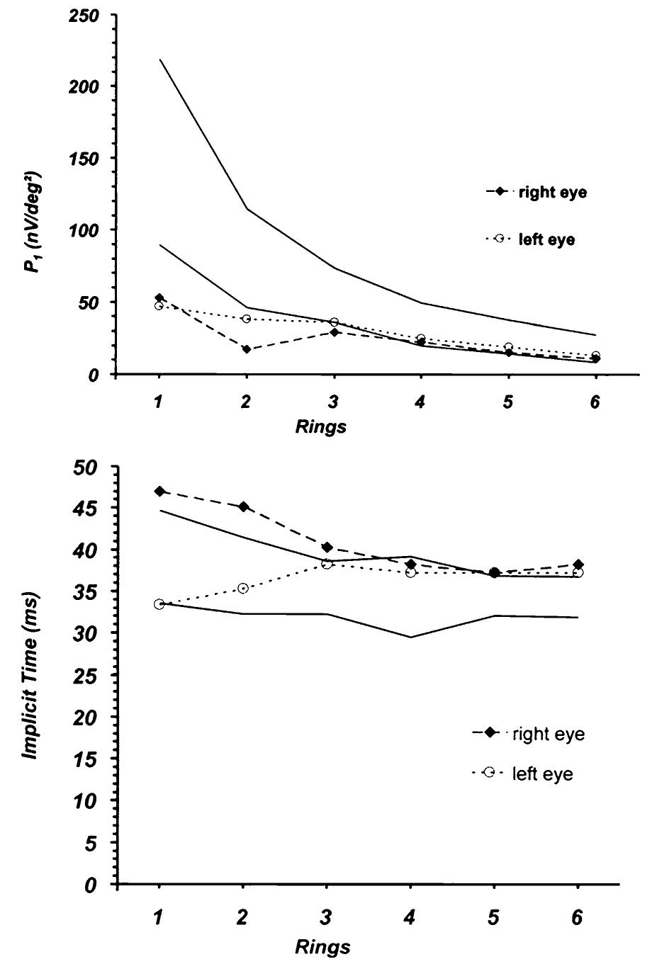Multifocal Power Rings (PDF) A 43-year-old man with reduced visual acuity and normal fundus ...